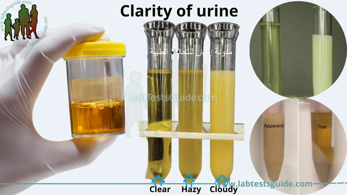 Cloudiness in Urine